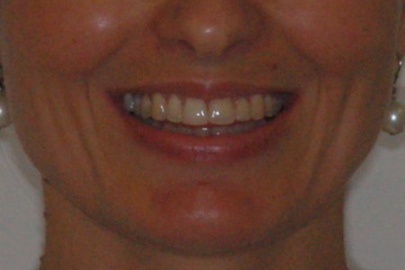 Diastema- úsměv po léčbě